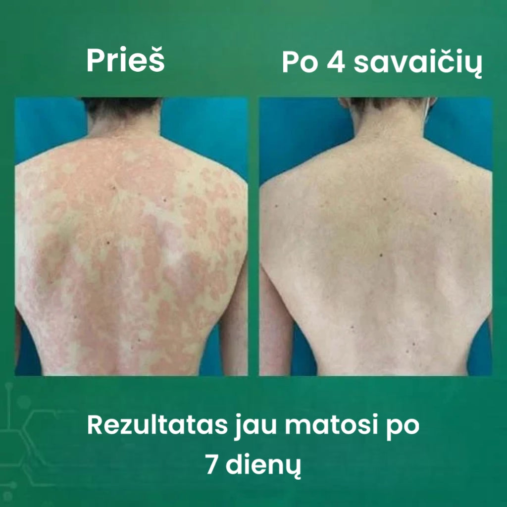 Natūralus žolelių augalų psoriazės kremas